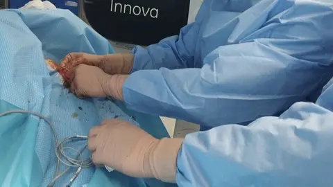 Nueva t&eacute;cnica empleada en el Hospital Punta Europa, Algeciras