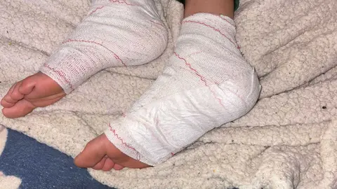 Los pies del menor, de solo 11 a&ntilde;os, permanecen vendados tras las graves quemaduras sufridas durante la brutal agresi&oacute;n en una vivienda de Los Barrios.